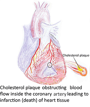 cholesterol plaque formation and heart attack