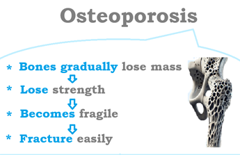 The right way to Forestall Osteoporosis Naturally with Food regimen and Train